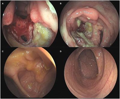 The Twists and Turns of Diagnosis and Treatment of Pediatric Neuro-Behcet's Disease: A Case Report and Literature Review